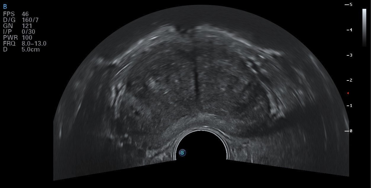 transrektaler hochauflösender Ultraschall der Prostata